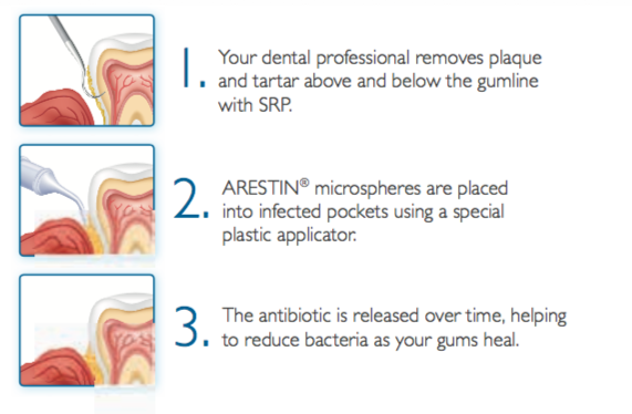 Deep Pockets in gums - Arudhra dental care