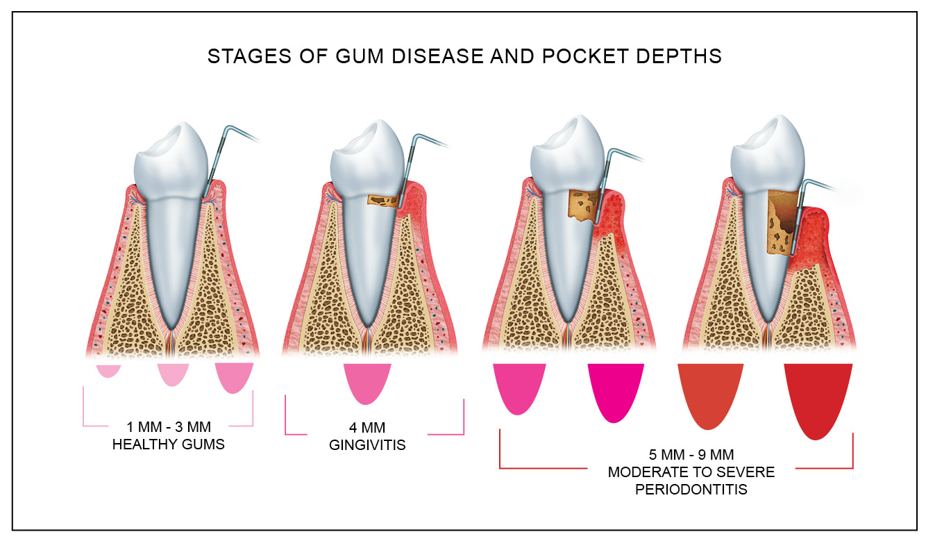 Printable Periodontal Probing Chart